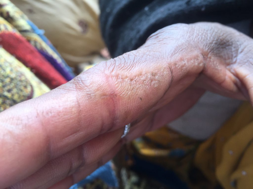 A women agriculture worker's injuries during vegetable picking.